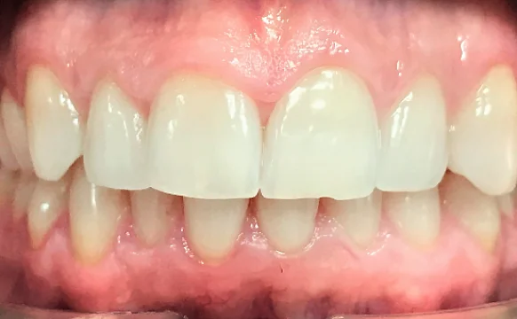 Исправление прикуса. 27 кап, 14 месяцев лечения