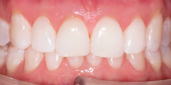 Исправление глубокого дистального прикуса