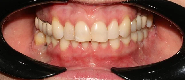 Лечение скученности зубов на брекет-системе