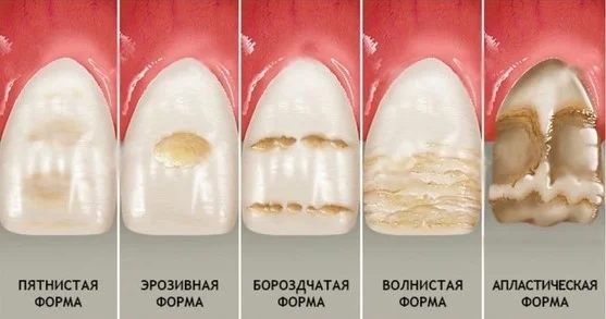 формы гипоплазии эмали фото