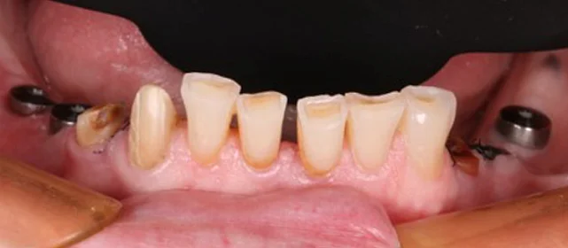 Полное протезирование нижнего ряда, установка виниров