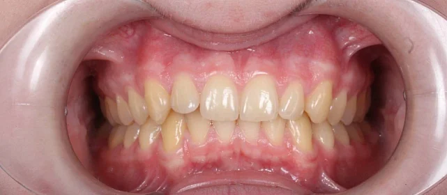 Ортодонтическое лечение на брекет-системе №4