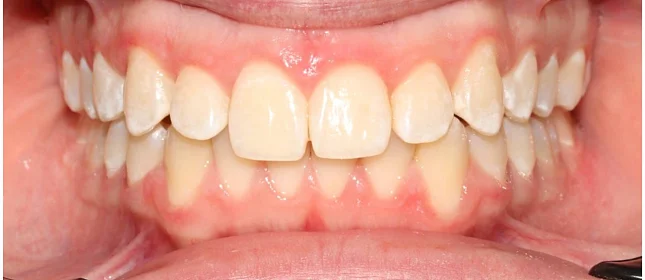 Ортодонтическое лечение на системе Click №4