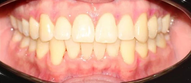 Ортодонтическое лечение на элайнерах №2