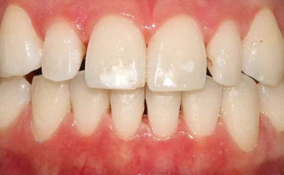 Коррекция аномалии положения зубов на элайнерах