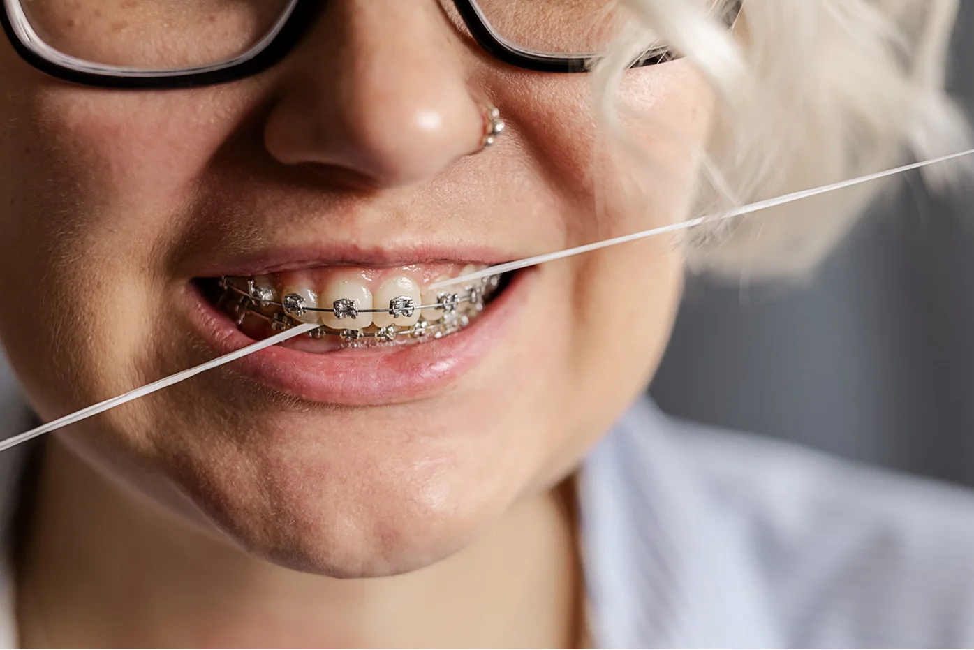 Как проходит процесс установки брекетов?