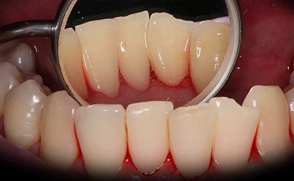 Удаление камней и профессиональная гигиена для последующего лечения кариеса