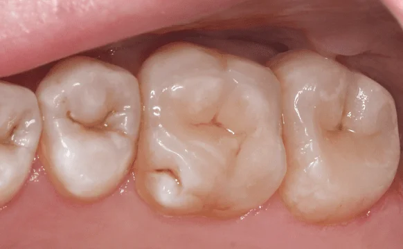 Восстановление эстетики с помощью виниров и вкладок (часть 2)