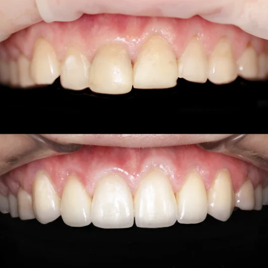 Протезирование зубов верхней челюсти винирами