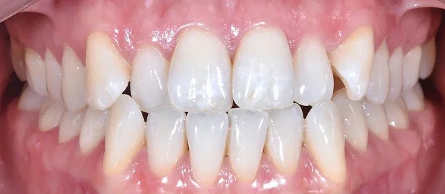 Соотношение зубных рядов до 3 классу Энгля, скученное положение зубов. Срок лечения 2 года