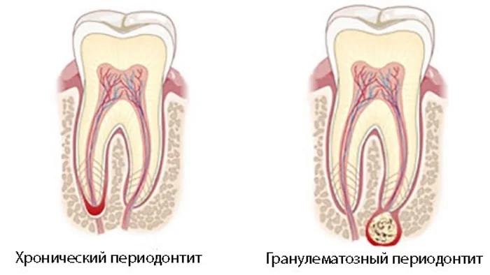 хронический периодонтит