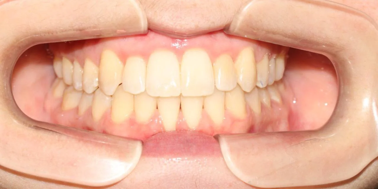 Корреция открытого прикуса элайнерами