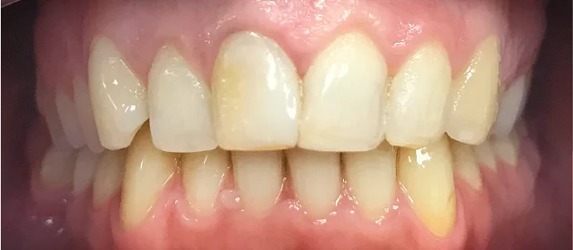 Исправление прикуса