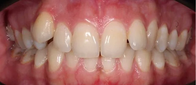 Ортодонтическое лечение на брекет-системе №2