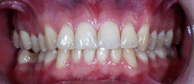 Лечение аномалии соотношений зубных дуг на брекет-системе