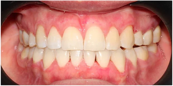 Ортодонтическое лечение на элайнерах