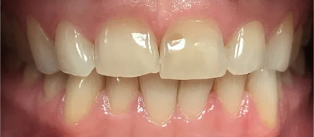 Нормализация смыкания и устранение скученности