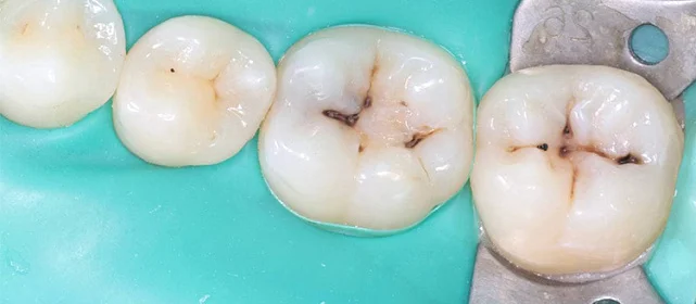 Эстетическая реставрация жевательной группы зубов