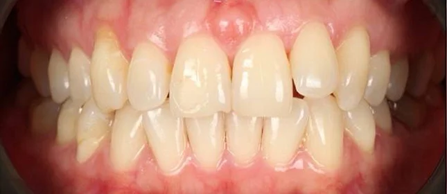 Лечение прикуса на брекет-системе