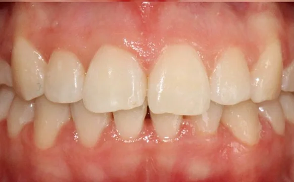 Ортодонтическое лечение нa брекет-системе