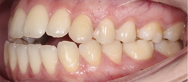 Расширение верхней челюсти элайнерами