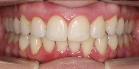 Лечение скученности зубов на элайнерах