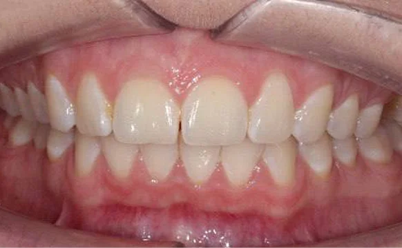 Коррекция дистального прикуса элайнерами