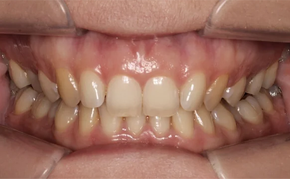 Ортодонтическое лечение на элайнерах