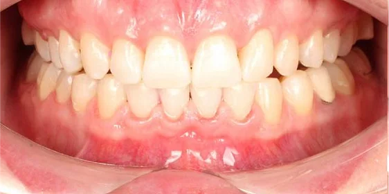 Коррекция дистальной окклюзия на брекет-системе