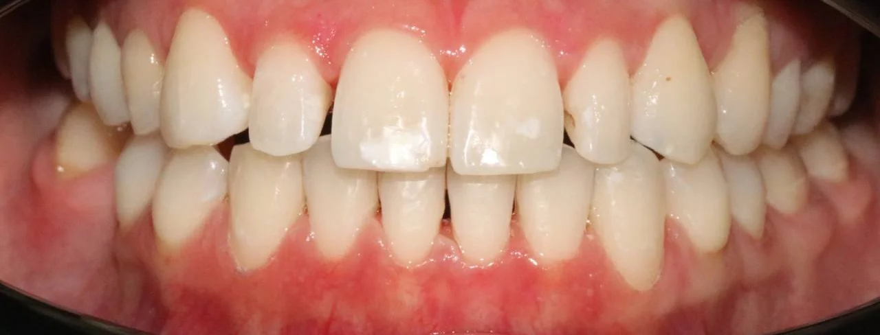 Коррекция аномалии положения зубов на элайнерах