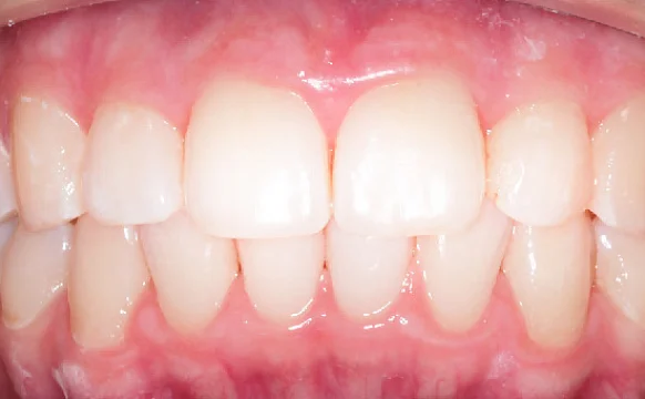 Лечение скученности зубов капами Инвизилайн