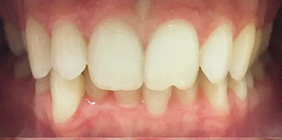 Лечение ретрузионного наклона верхних резцов с последующей реставрацией