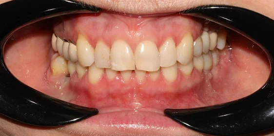 Лечение скученности зубов на брекет-системе