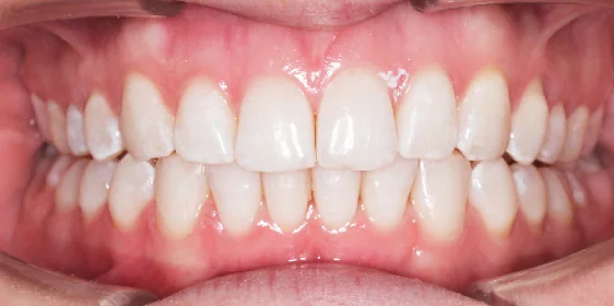 Исправление прикуса. 29 кап, 14 месяцев лечения