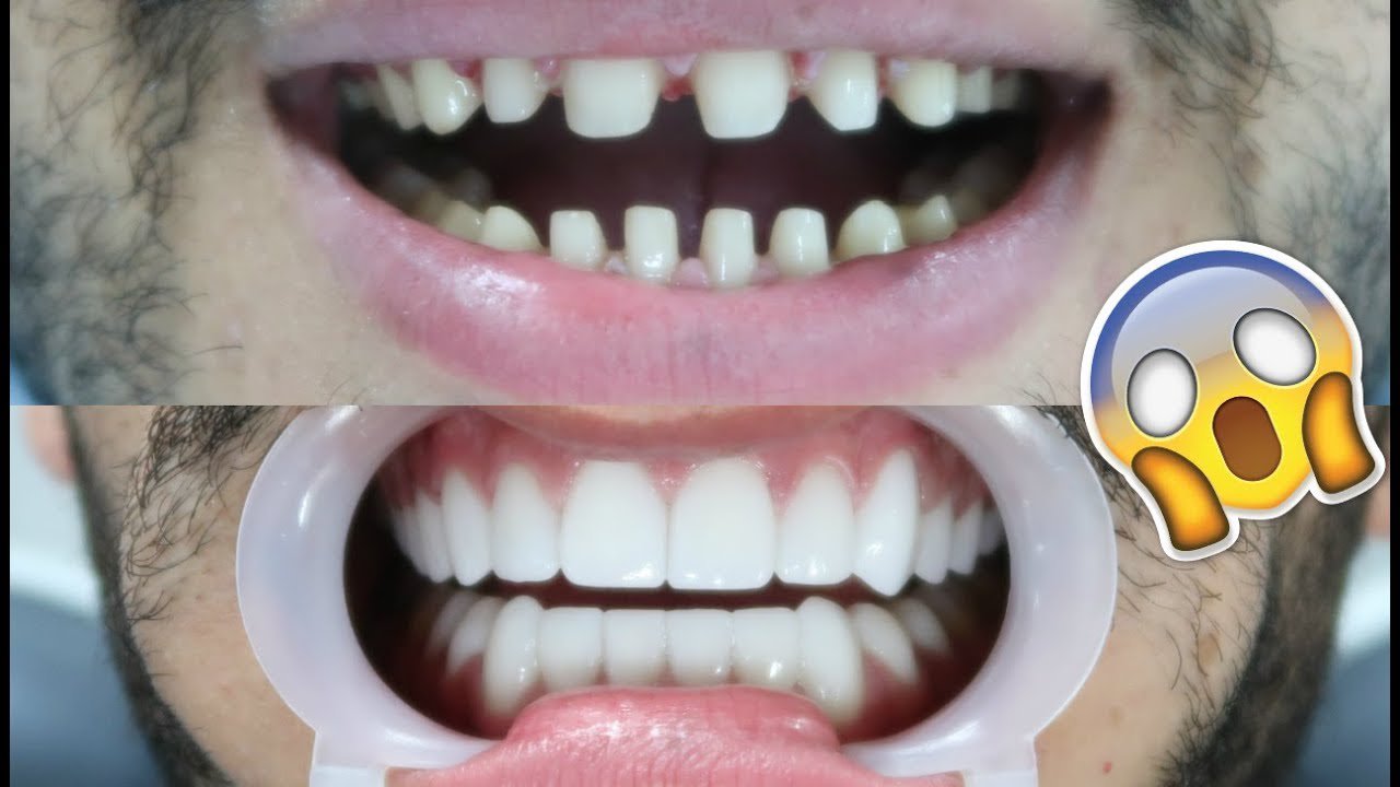 Эстетика зубов после виниров
