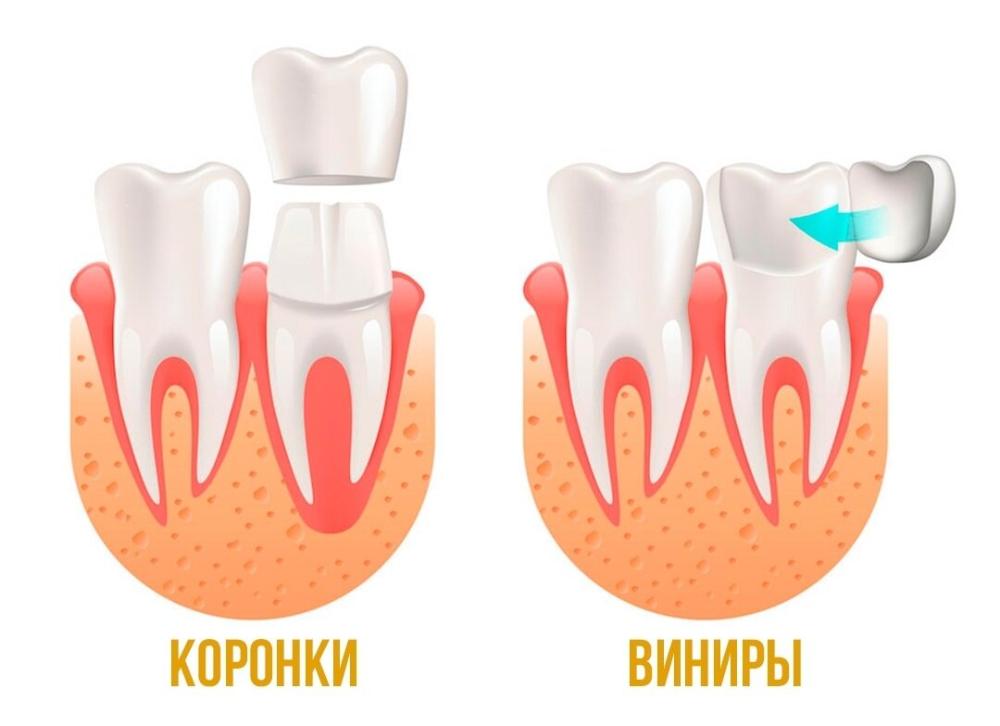 Виниры или коронки