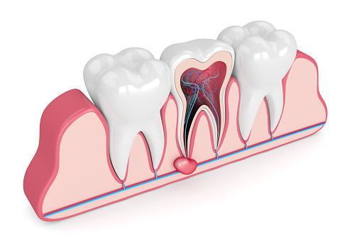 Что такое киста зуба и как она образуется