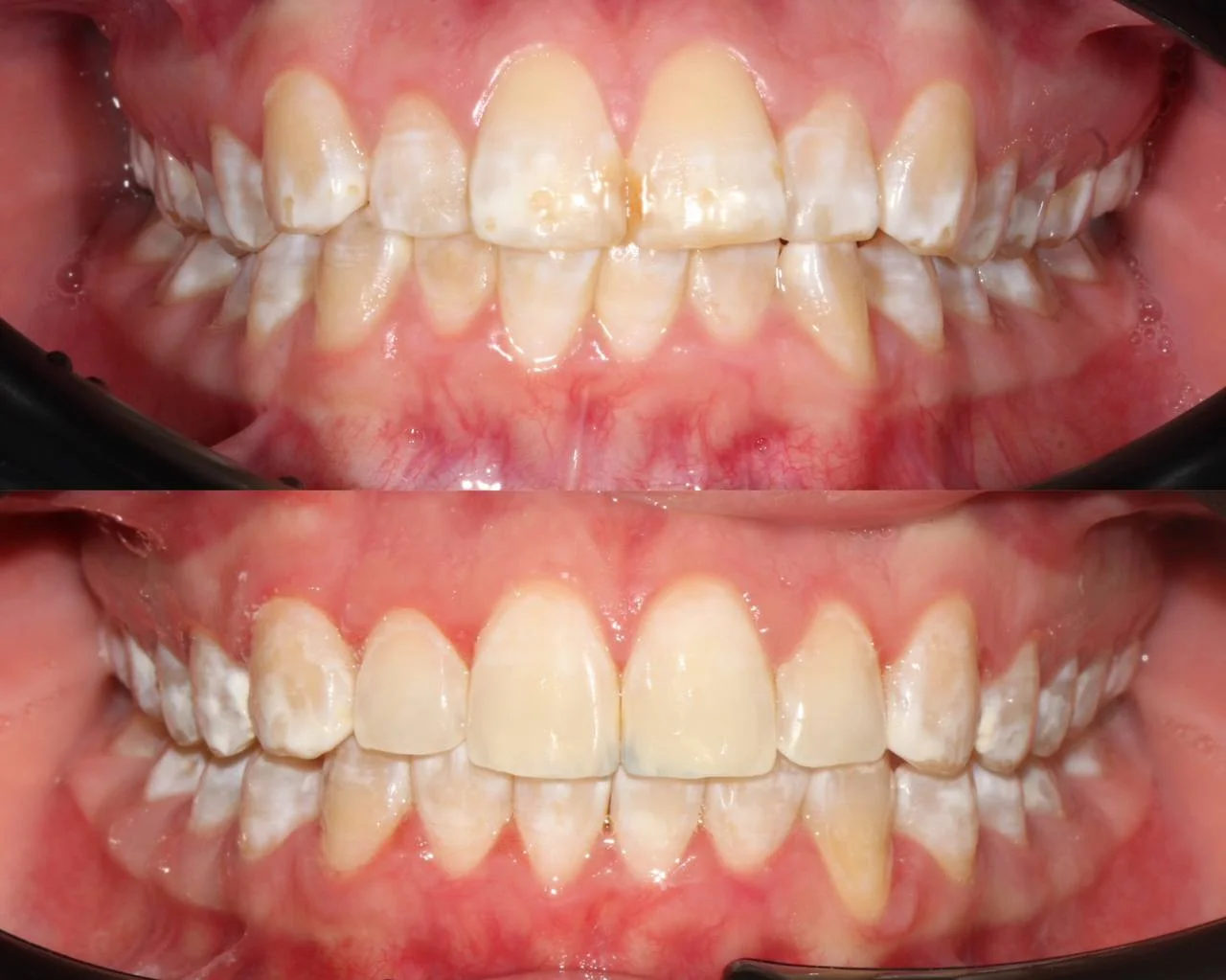 Неправильный прикус и положение зубов — лечение на элайнерах Click