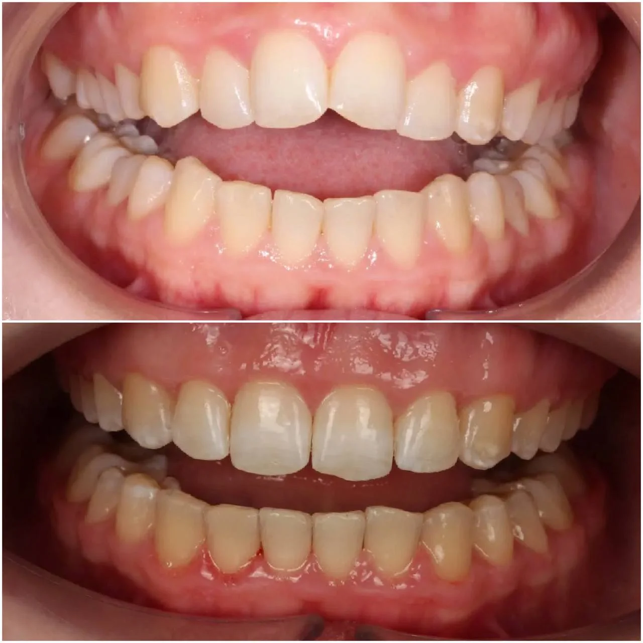 Сужение челюстей и боль в суставе — лечение на брекетах H4