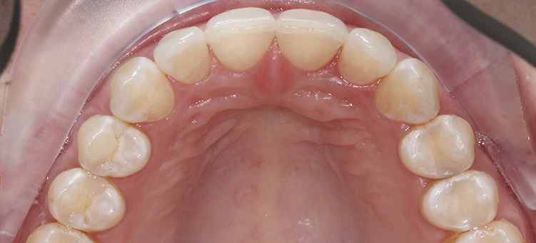Изменение скученности зубов с помощью системы Invisalign