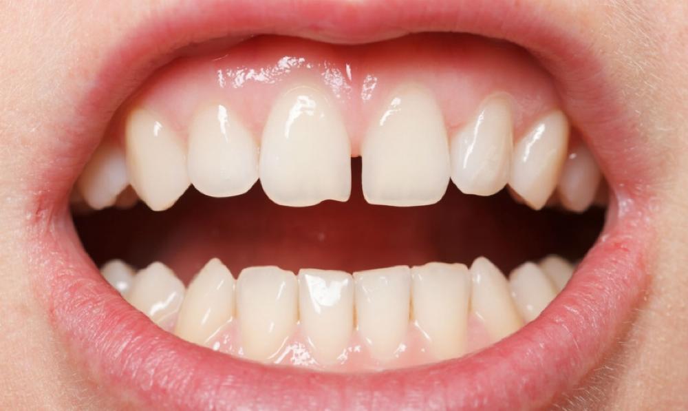 Разъехались зубы после протезирования – решение проблемы