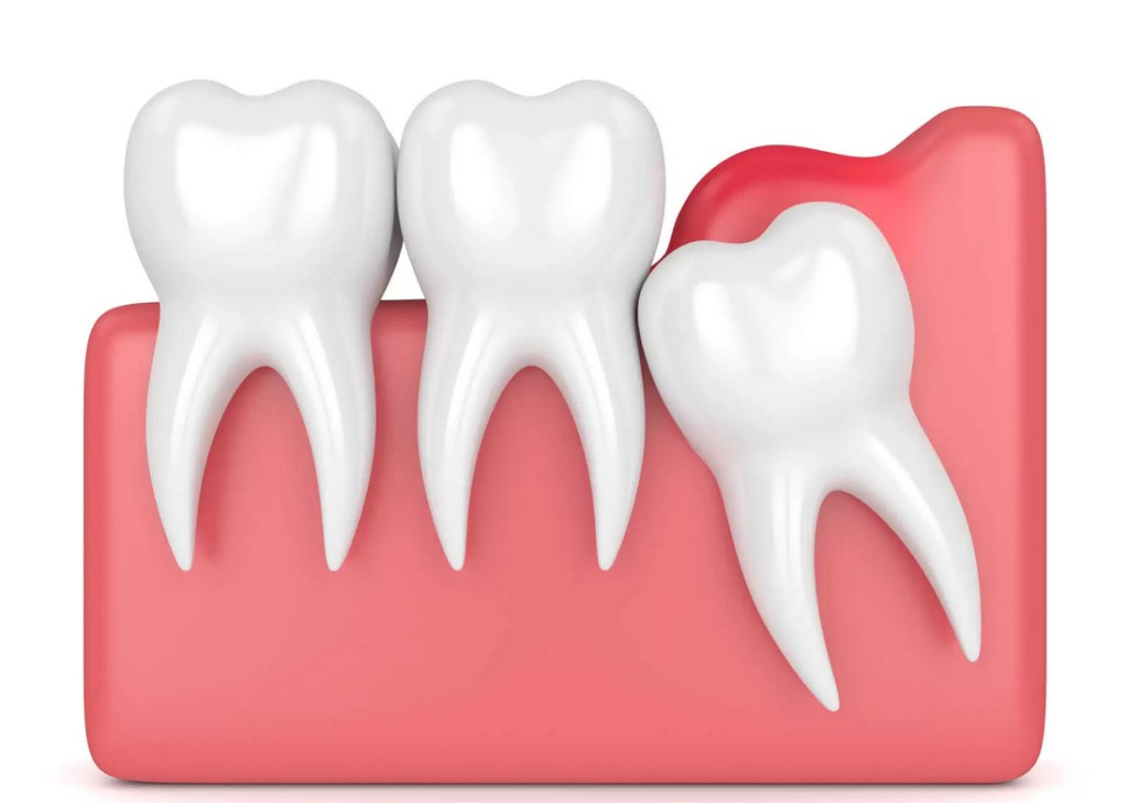 Перикоронит зуба мудрости: симптомы заболевания, лечение воспаления капюшона десны, удаление