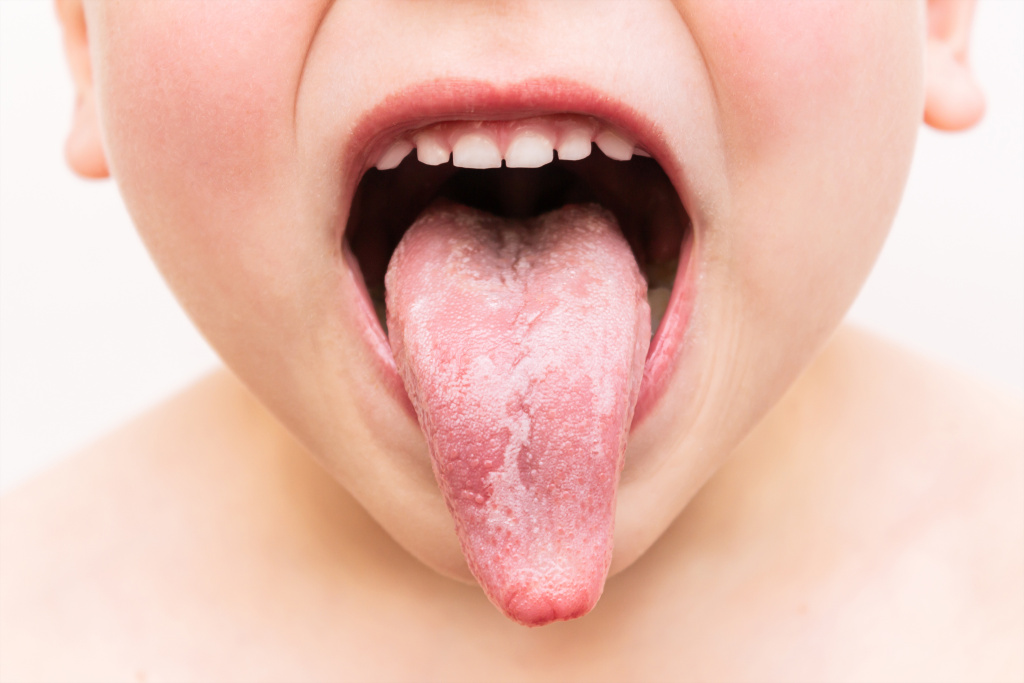 Симптомы, причины и лечение глоссита языка