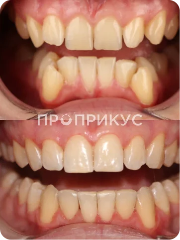 Ортодонтическое лечение на брекет-системе Damon