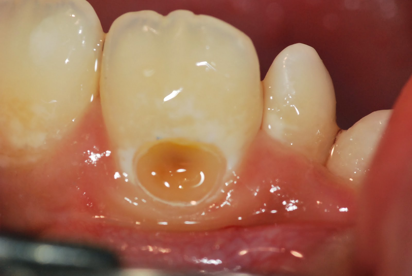 Пример пришеечного кариеса зуба