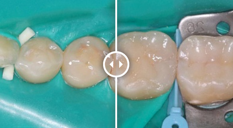 Реставрация зубов (до после) - изображение 3