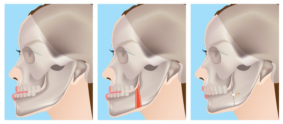 ортодонтическая операция челюсти