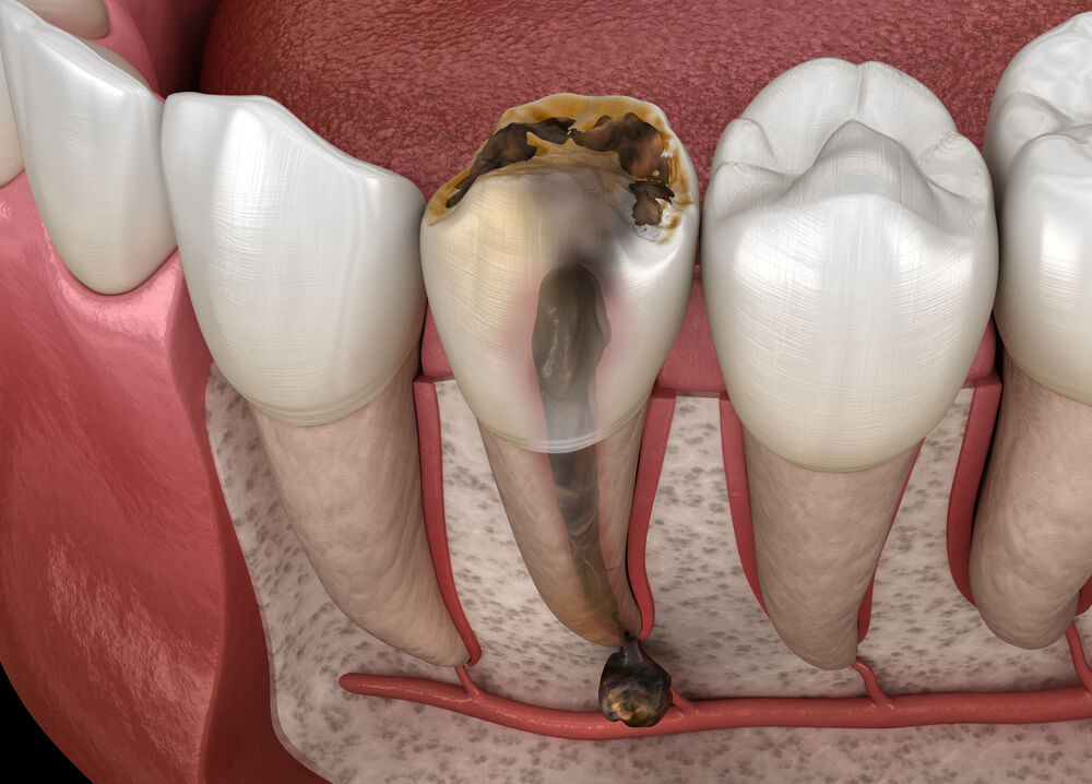 удаление нерва зуба фото
