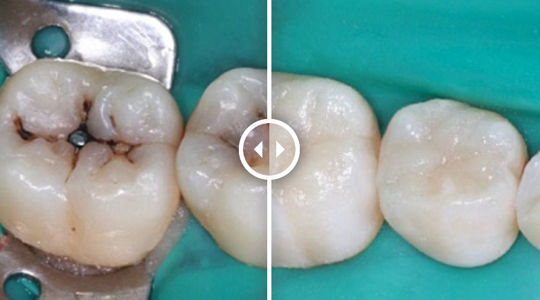 Реставрация зубов (до после) - изображение 4