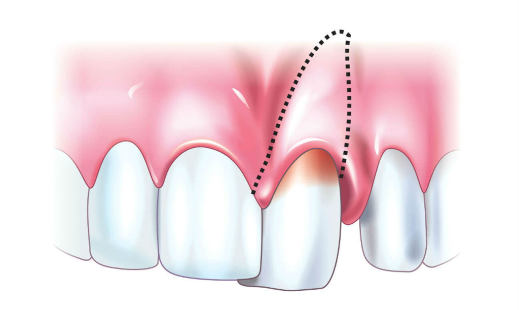 симптомы перфорации зуба фото